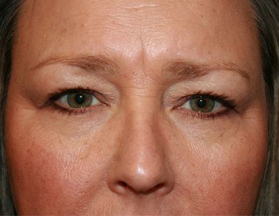 before blepharoplasty