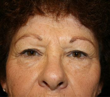 woman before brow lift