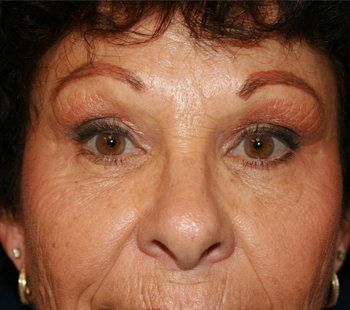 woman after brow lift