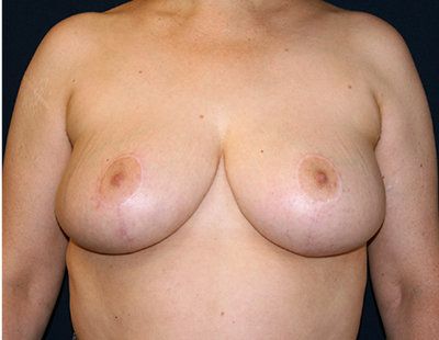 After breast reduction